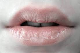 16 домашних способов вылечить треснутые губы за 5 минут
