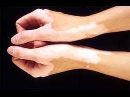 25 эффективных способов профилактики белых пятен на коже