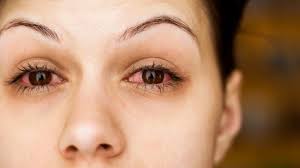 5 причин налитых кровью глаз после родов: лечение, рекомендации