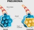 12 натуральных и безопасных средств для лечения пневмонии