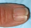 6 причин сломанных и расслоенных ногтей- Симптомы и Лечение