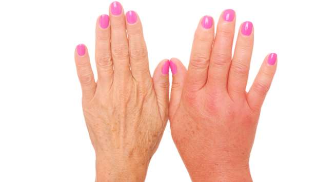 17 натуральных способов вылечить опухшие пальцы за 30 минут