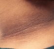 10 причин темной полосы вокруг шеи у полных людей и его лечение