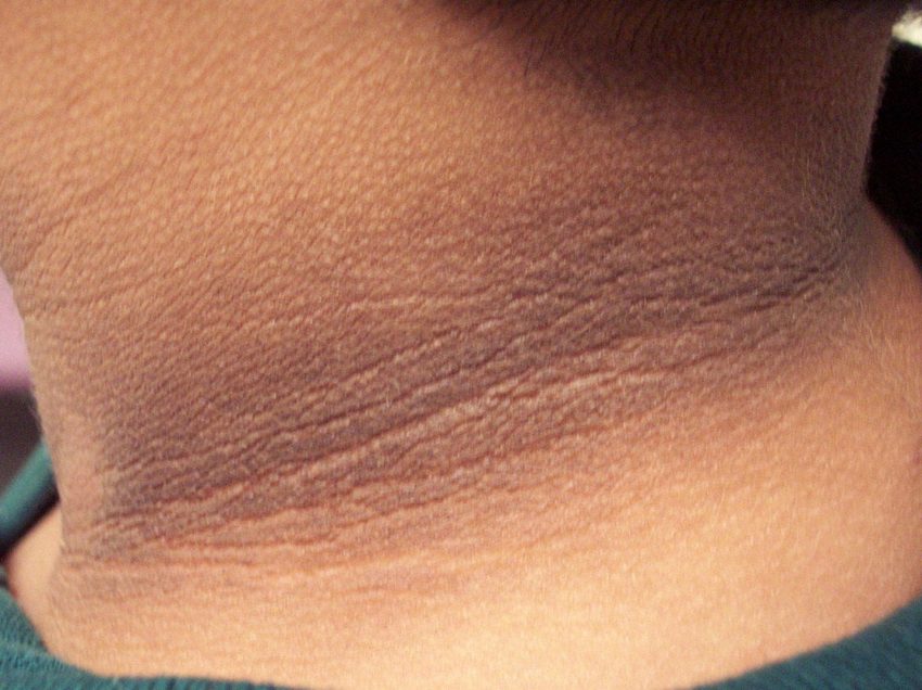 10 причин темной полосы вокруг шеи у полных людей и его лечение