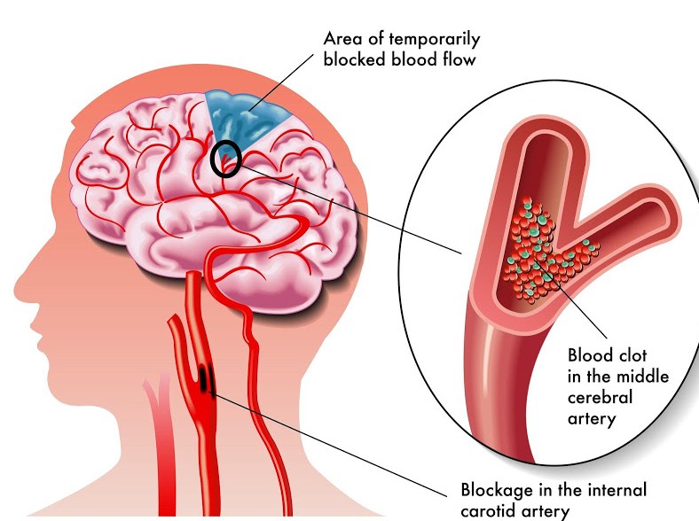 Закупорка кровеносных сосудов в мозгу (причины, опасность, лечение)