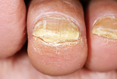 17 лекарств от грибка ногтя на ноге – естественные средства
