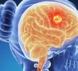 Доброкачественные опухоли головного мозга (симптомы и лечение)