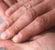 То, что вызывает волнистость ногтей может быть симптомом заболевания