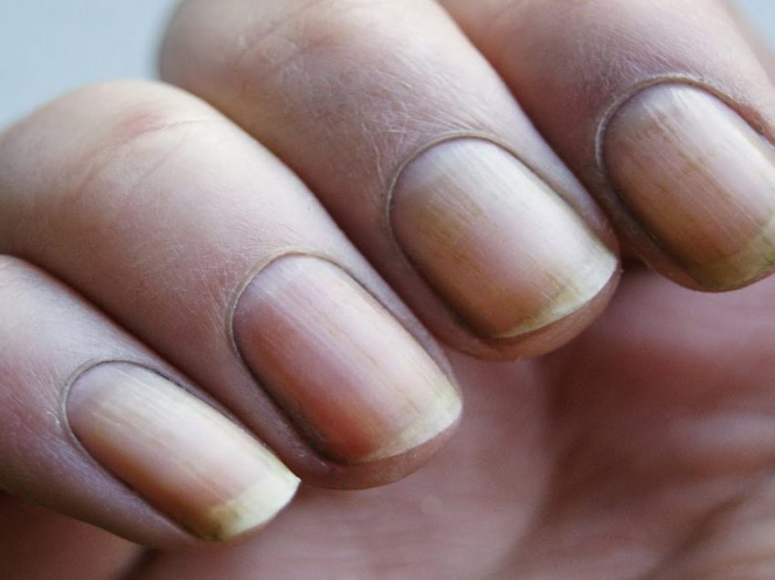 29 естественных способов лечения желтых ногтей дома
