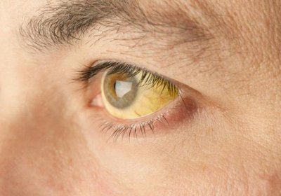 20 эффективных способов предотвратить пожелтение глаз