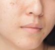 8 быстрых способов устранения шрамов ветрянки на лице
