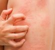 11 Симптомов крапивницы по всему телу и опасности