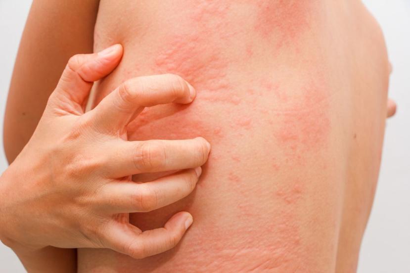 11 Симптомов крапивницы по всему телу и опасности