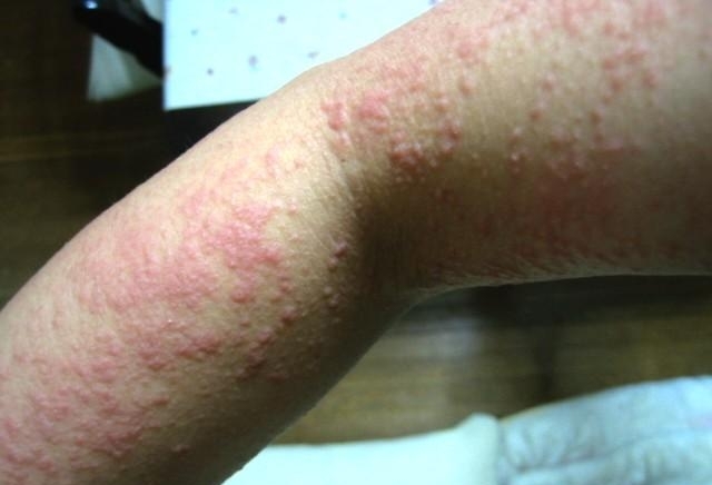 11 способов преодоления холодовой аллергии на коже