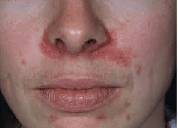 9 причин шелушащейся и сухой кожи вокруг носа (включая лечение)