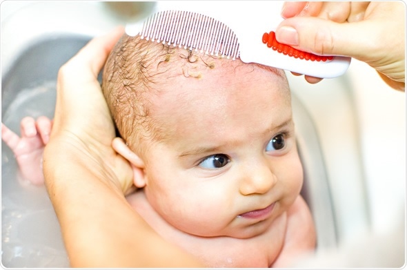 6 методов избавиться от себорейного дерматита у младенцев