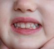 Пигментация зубов у малышей – причины, лечение, профилактика.