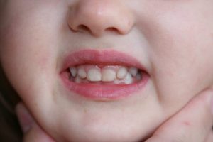 pigmentation of child's teeth