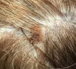 Как узнать, есть ли у вас рак кожи на коже головы