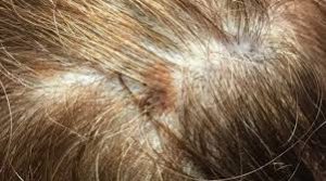 cancer on skin scalp