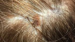 Как узнать, есть ли у вас рак кожи на коже головы