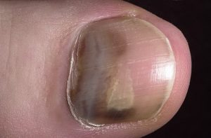 cancer skin on nail