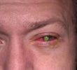 Инфекция глаз и контактные линзы (надо знать)
