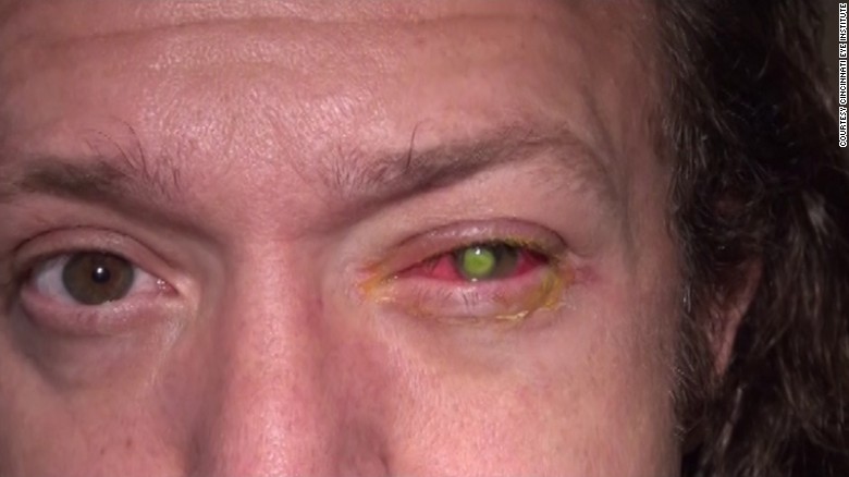 Инфекция глаз и контактные линзы (надо знать)