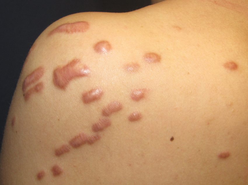 Келоидный шрам – симптомы, причины, лечение, профилактика
