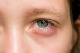 10 способов предотвратить опухшие глаза после плача ночью