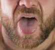 11 фактов о раке языка (включая рекомендации лечения)