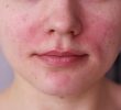 Правильное лечение сухой кожи на лице – Это работает!