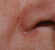 Причины шелушащейся кожи вокруг носа (рекомендации)