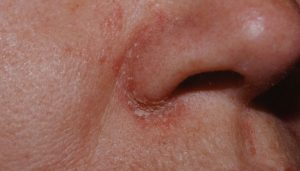 Причины шелушащейся кожи вокруг носа (рекомендации) - lyekarstvo