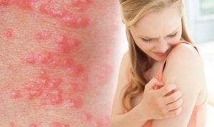 treat scabies without doctor