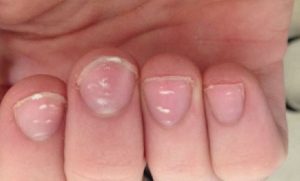 white spots on nail