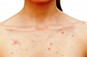 acne on chest