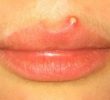 8 причин появления прыщей на губах – лечение