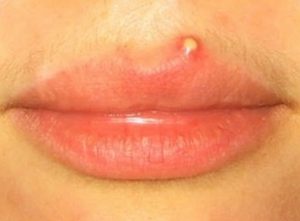 acne on lip