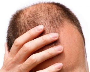 bald spots on forehead