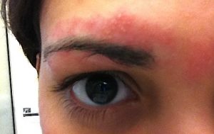 bumps after waxing eyebrows