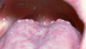 bumps on back of tongue