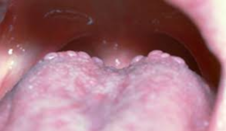 12 причин шишек сверху языка и их лечение