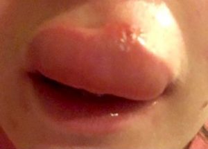 lip swelling