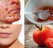 Как предотвратить прыщи с помощью томатной маски