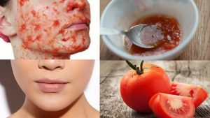 tomato mask for acne