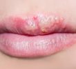 30 факторов, вызывающих белые пятна на верхней губе