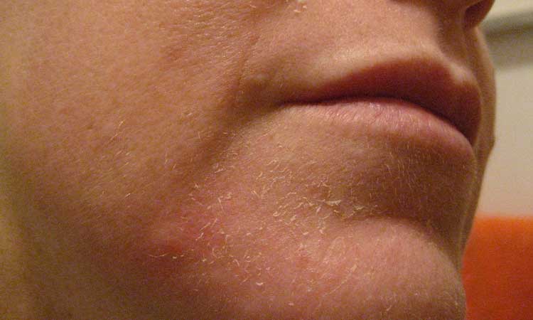 Правильное лечение  шелушащийся кожи