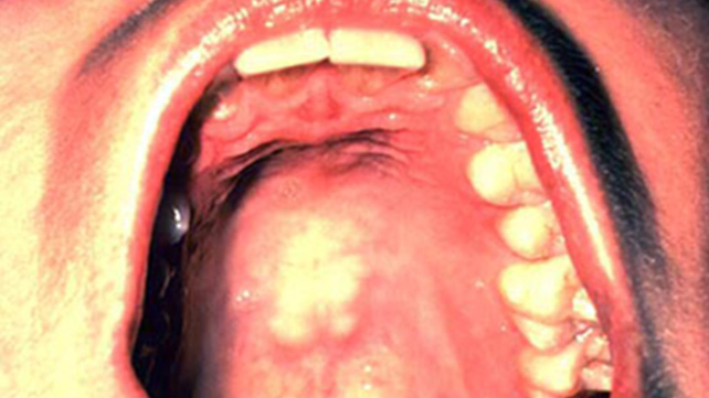 3 характеристики рака полости рта – профилактика