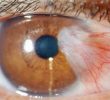 Птеригиум глаза: причины, симптомы, лечение, профилактика
